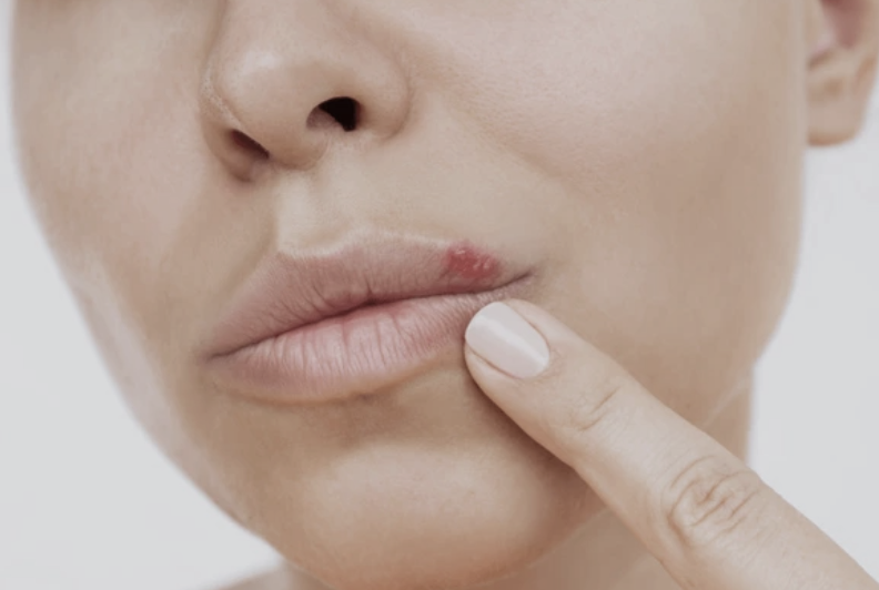 Herpes und Genitalherpes